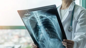 মালয়েশিয়ায় দ্রুত ছড়াচ্ছে যক্ষ্মা, বিশেষ সতর্কতা জারি।